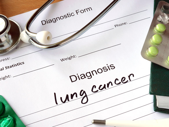 Lung Cancer in Singapore Diagnosis