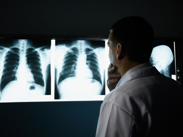 What is Lung Cancer Xray